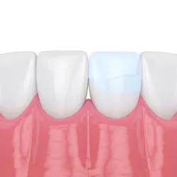Dental illustration showing healthy teeth and gums with dental implant or restorative procedure