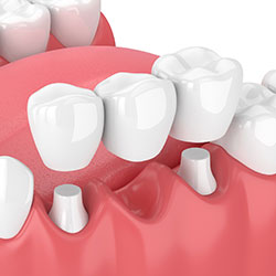 Medical illustration showing dental implants in cross-section view with artificial tooth roots embedded in jaw bone and gums
