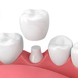 3D dental illustration showing dental implant post between natural teeth in gum tissue