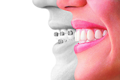 Split comparison image showing orthodontic braces treatment on one side and perfect smile result on the other side