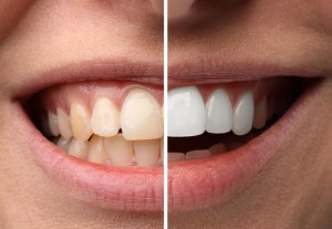Happy young woman in white shirt smiling and pointing to her healthy teeth
