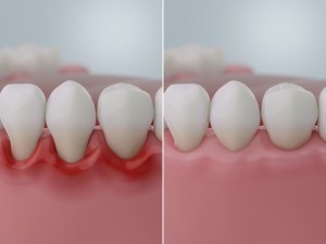Gum Disease Treatment